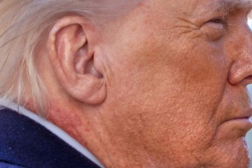 트럼프 목에 포착된 '의문의 붉은 자국'… 백악관, 건강 이상설에 "연고 사용 때문"