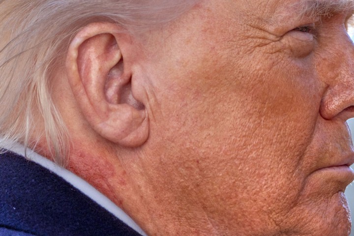 트럼프 목에 포착된 '의문의 붉은 자국'… 백악관, 건강 이상설에 "연고 사용 때문"