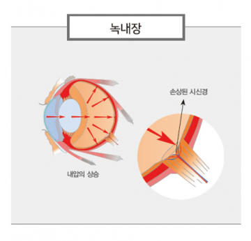 시력을 지키기 위해 꼭 알아두어야 할 안질환 ‘백내장과 녹내장’