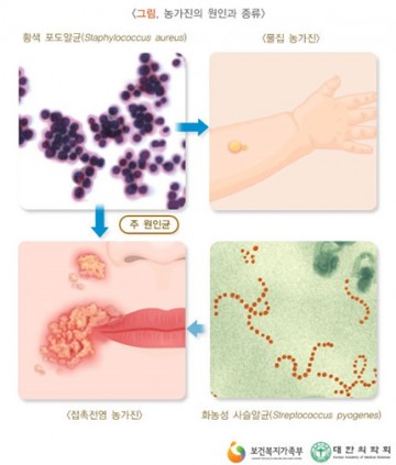 여름철 '농가진'주의 증상과 예방법은?