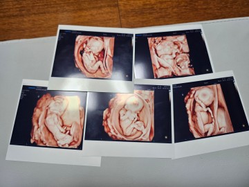 다섯쌍둥이 출산에 尹대통령, "엄마아빠·의료진에 감사"